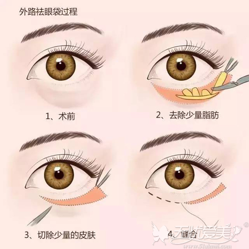 宜昌星范外路法祛眼袋手术原理