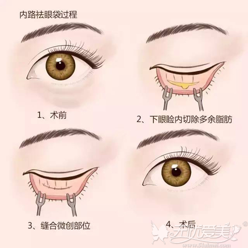 宜昌星范内路法祛眼袋手术过程