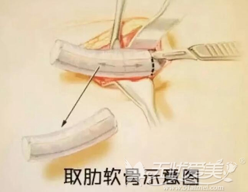 深圳嘉美自体肋骨隆鼻材料取出部位