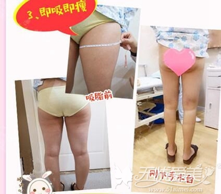 南京爱薇大腿吸脂手术案例