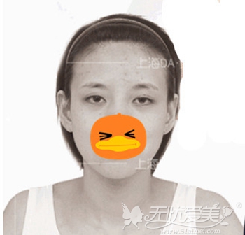在上海DA美联臣做面部轮廓手术前