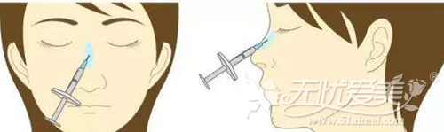 玻尿酸注射隆鼻效果