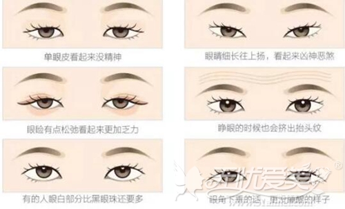 伊丽莎白韩式双眼皮手术可以改善眼部问题