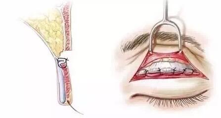 Park法双眼皮手术方法