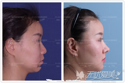 上海伊莱美坐诊医生刘安堂隆鼻修复案例
