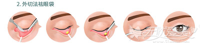 韩镜外切法祛眼袋手术过程