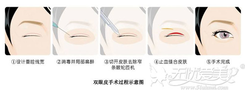 双眼皮手术过程原理