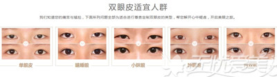 双眼皮的多种类型