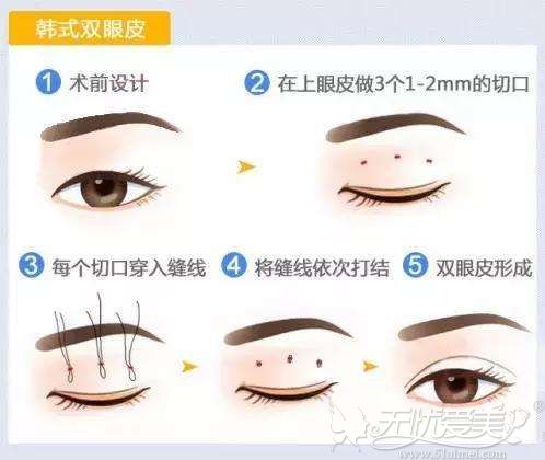 韩式双眼皮手术