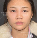 有幸成为北京柏丽招募的免费鼻综合模特 从此改变塌鼻人生