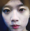 忍不住分享我在韩国纯真做双眼皮+鼻综合手术的恢复全过程