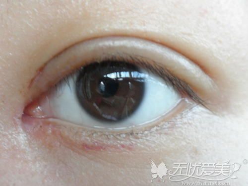 双眼皮术后稳定时期开始疤痕增生