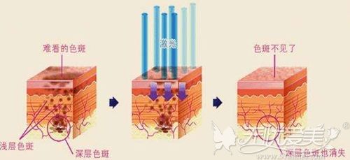 无锡坤如玛丽激光祛斑原理