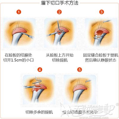 广东画美上睑下垂手术过程解析