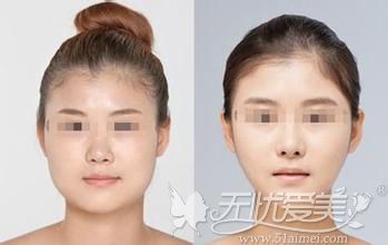 广安华美悦美改脸型手术案例
