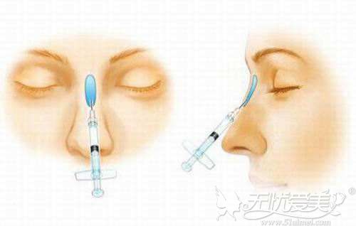 驳玻尿酸隆鼻的注射位置