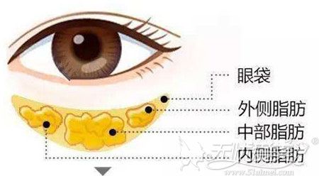威海威高梨花分析眼袋的形成