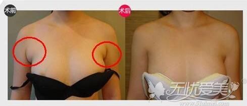 广州曙光水动力吸脂去副乳案例