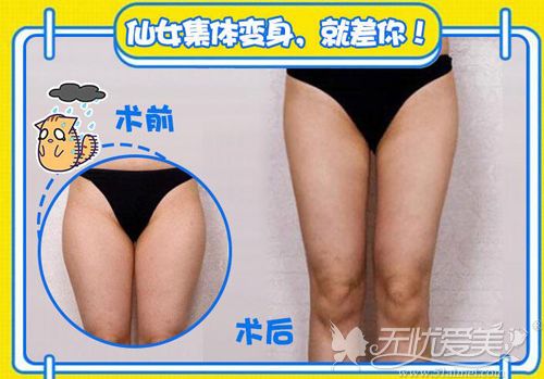 蚌埠华美大腿吸脂真实对比案例