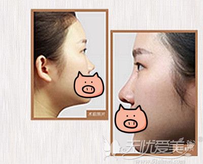 衡阳曹家的5D美雕综合隆鼻术案例