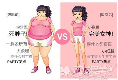 肥胖通过吸脂可以变小蛮腰