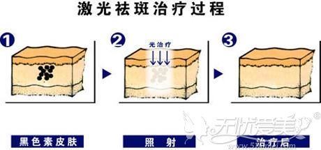 激光去日晒斑原理