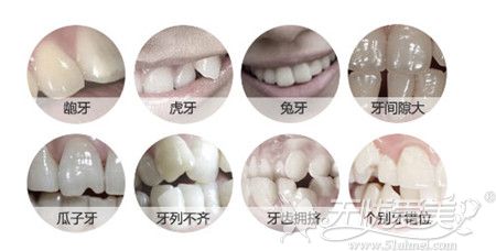 牙齿矫正可以改变的几种牙齿类型