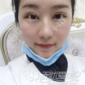 长沙雅美做双眼皮手术后5天