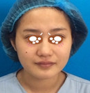 沈阳和平元辰护士张彤经历了鼻综合和面部填充后的变化