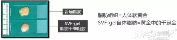 福州涣美极脂胶(SVF-Gel)技术