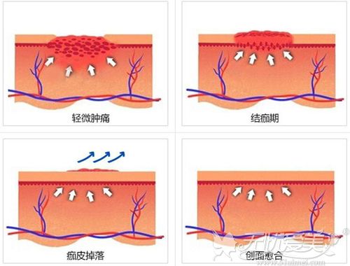 激光点痣后的皮肤恢复