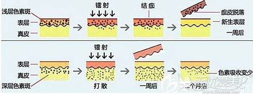 鹰潭美嘉激光祛斑原理