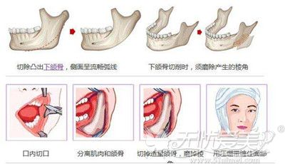 广州博仕弧线改脸形过程解析