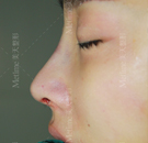一个鼻子改变一张脸 在承德美天做全仿生综合鼻整形过程史