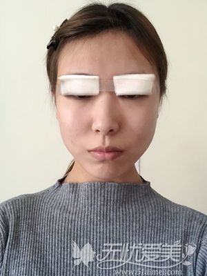 在山西整形外科做双眼皮手术即刻