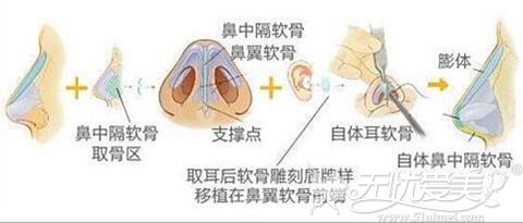 威海孙漫鼻综合整形手术