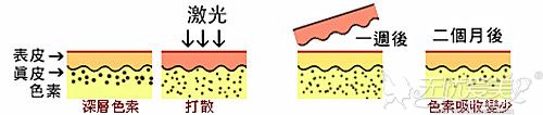 威海孙漫激光祛斑过程解析