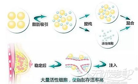 威海孙漫自体脂肪丰胸原理