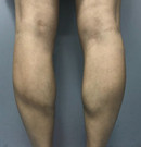 瘦腿针有用吗？我在佛山医博士3个月的瘦腿经历说明一切术前