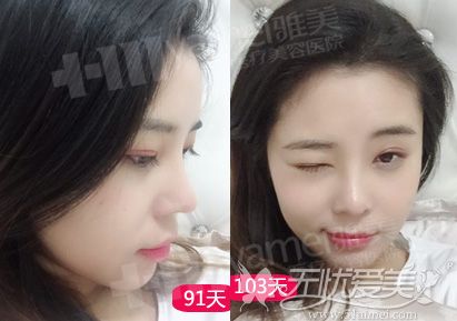 顾客在长沙雅美隆鼻后的效果