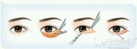 许昌丽娜韩式无痕祛眼袋的手术流程