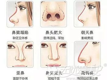 达拉斯隆鼻可以解决多种鼻部问题