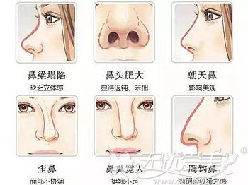 深圳江南阳光达拉斯综合隆鼻术