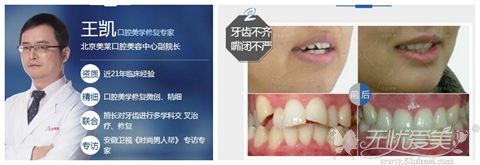 北京美莱王凯牙齿隐形矫正案例