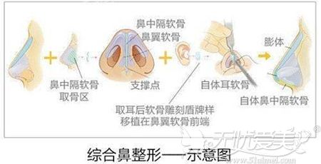 梁青松院长解析达拉斯综合隆鼻原理