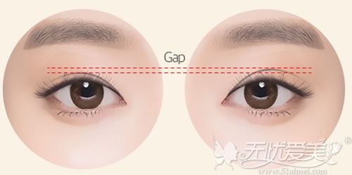 韩国TJ整形双眼皮不对称修复