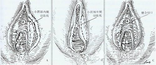 阴唇整形手术过程