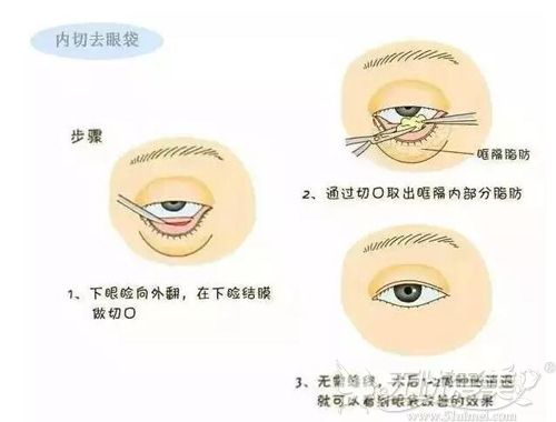 内切祛眼袋手术过程