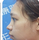 历经千挑万选在重庆康雅做假体隆鼻30天后收获满意效果