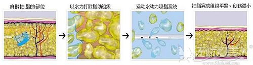 西安鹏爱水动力吸脂原理